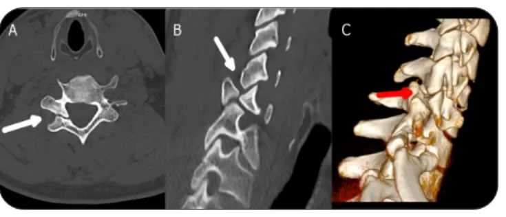 Figure 2. Scintigraphie et SPECT-CT du rachis cervical montrant un foyer d’hyperfixation   interapophysaire postérieure au niveau C5-C6 droite sans hyperfixation au niveau isthmique.