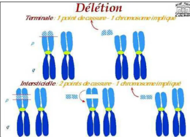 Figure 1. Délétion chromosomique terminale et interstitielle, source Orphanet. 