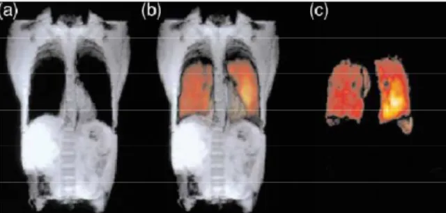 Figure 9 : (a–c) IRM in vivo de la cage thoracique après respiration d’un mélange de gaz  contenant du  129 Xe hyperpolarisé (a) En gris, IRM  1 H anatomique (b) Superposition des  images obtenues en IRM   1 H et  129 Xe où en rouge est représenté l’espace