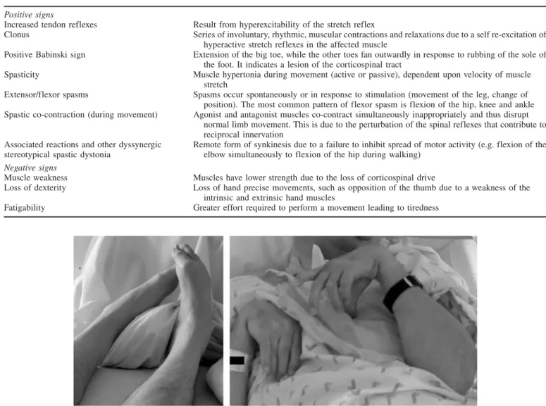Figure 1. Left: equinovarus feet; right: upper limbs with a spastic pattern in adduction and internal rotation of the shoulder and flexion of the elbow, wrist and fingers.