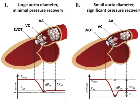 FIGURE 7. Pressure recovery. (I) Large aorta diameter, minimal pressure recovery. Pressure gradients between the LVOT and VC, and between the LVOT and AA are similar