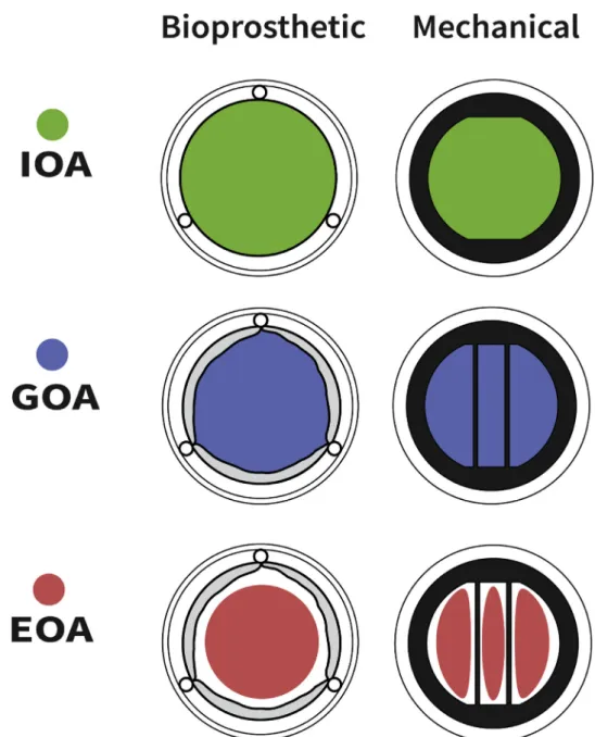 FIGURE 6. IOA, GOA, and EOA in bioprosthetic and mechanical valves. EOA, Effective orifice area; GOA, geometric orifice area; IOA, internal orifice area.