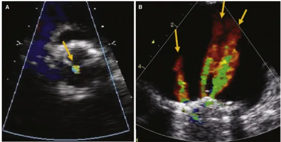 Fig 8. Normal regurgitant jet in bioprosthetic and mechanical valves. Normal