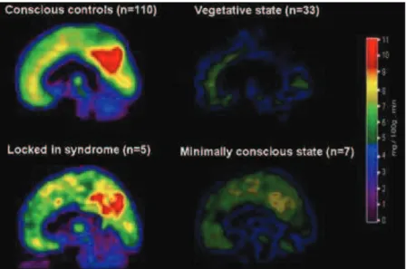 Figure 4 : Métabolisme cérébral au repos chez les individus sains (en haut à gauche), les patients en état  végétatif (en haut à droite), les patients avec le syndrome Locked-in, et les patients en état de conscience  minimale