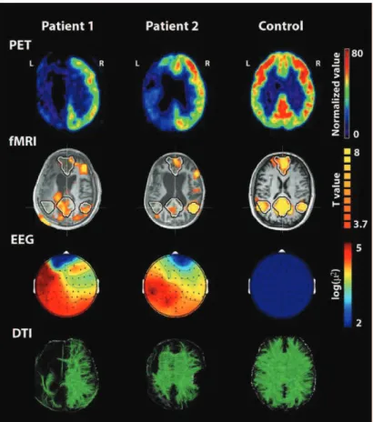 Figure 9 : Illustration de la neuro-imagerie multimodale à partir des résultats obtenus grâce à la  Tomographie à Emission de Positons au [18F]fluoro-2-désoxy-d-glucose (PET), l’Imagerie par Résonance  Magnétique fonctionnelle (fMRI), l’électroencéphalogra