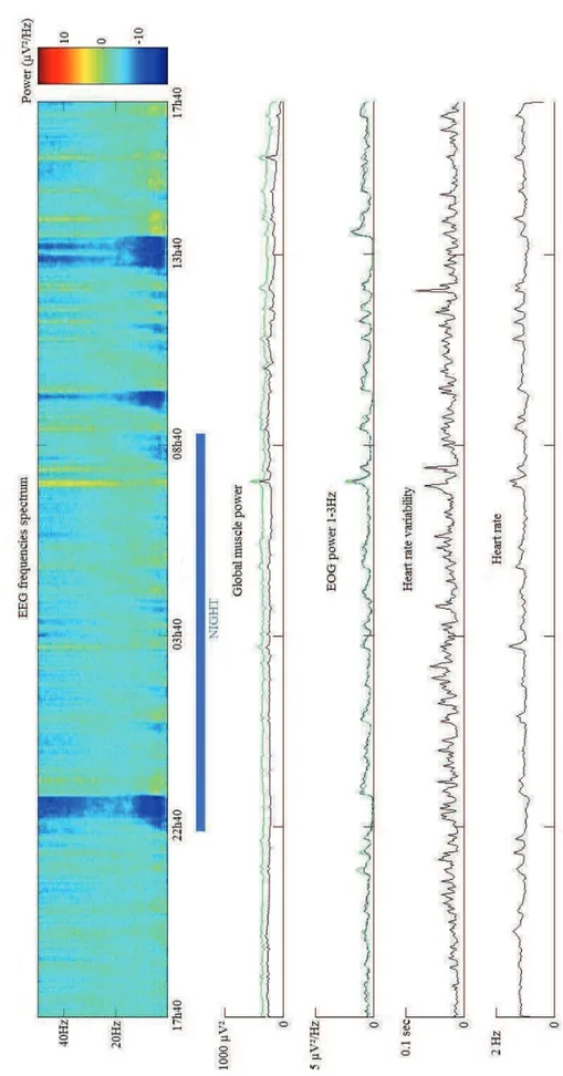 Figure 13 : Absence d’un cycle veille-sommeil pendant les 24h d’enregistrement. Le patient présente un rythme  biologique pratiquement monotone