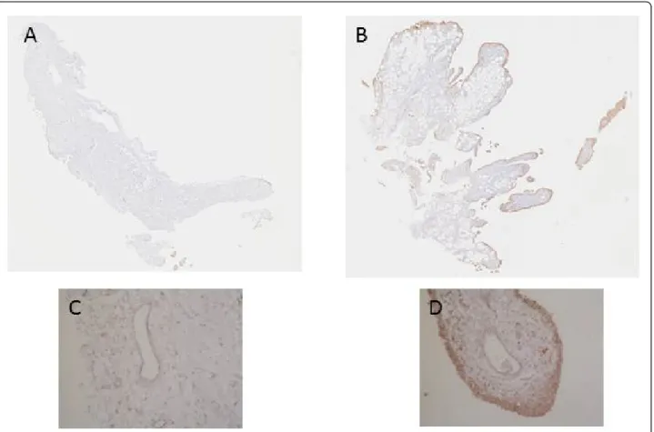 Figure 4 Immunohistochemical detection of VEGF in NR (A, and C) and in I (B and D) synovial biopsies