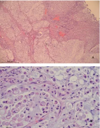 Figure 1A.  Adénocarcinome entérique infiltrant peu différencié, de  variante mucineuse (&gt;80%).