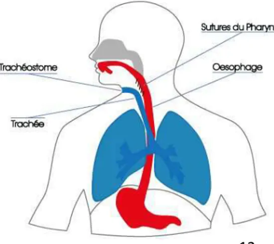 Figure 4 : Anatomie avant la LT                                                                  Figure 5 : Anatomie après la LT 
