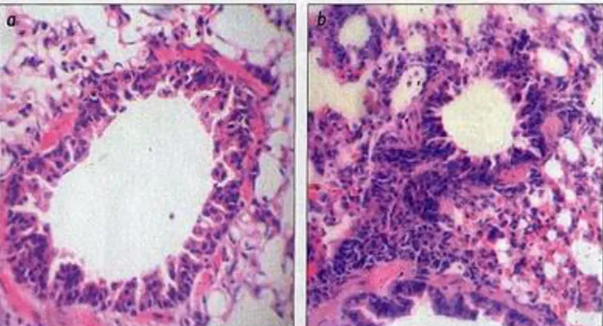 Figure 3 : Coupe de poumons au niveau des bronchioles chez un cochon d'Inde sain (a)  versus un cochon  d'Inde infecté (b) par le VRS