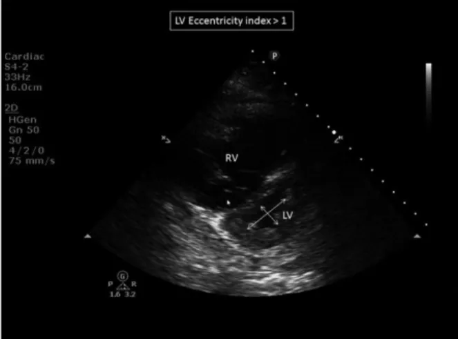 Figure 6 – Indice d’excentricité ventriculaire &gt; 1 en ETT coupe parasternale petit axe en systole