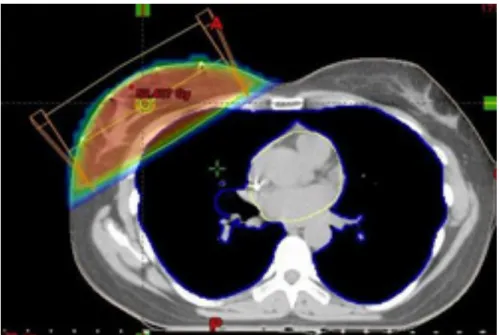 Figure 3. Coupe scannographique de répartition de la dose selon un traitement dit &#34;classique&#34; 