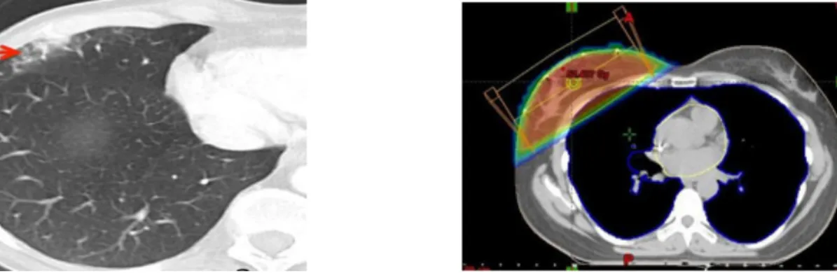 Figure 10. Aspect scannographique de fibrose pulmonaire après radiothérapie mammaire  conformationnelle par deux faisceaux tangentiels 