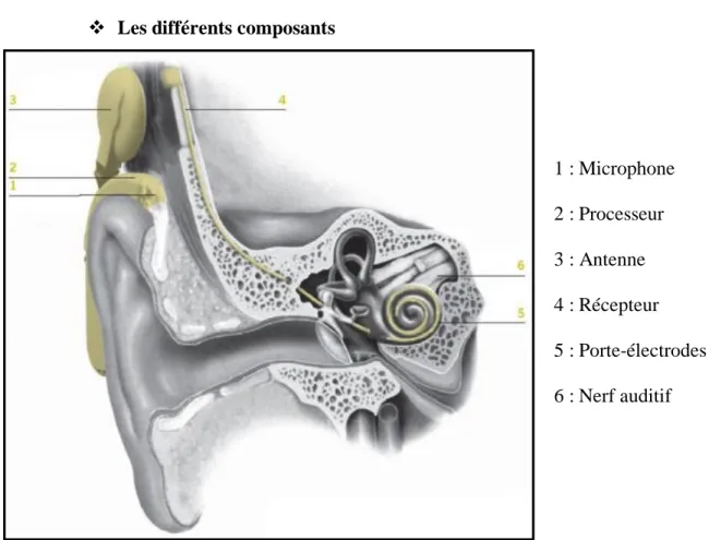 Figure 5: L'implant cochléaire