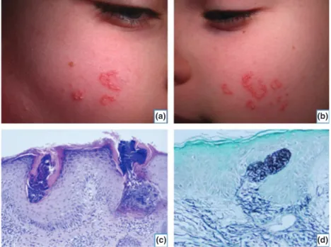 Figure 1 Well-circumscribed erythematous and hyperkeratotic serpiginous papules of the left (a) and right (b) cheeks.
