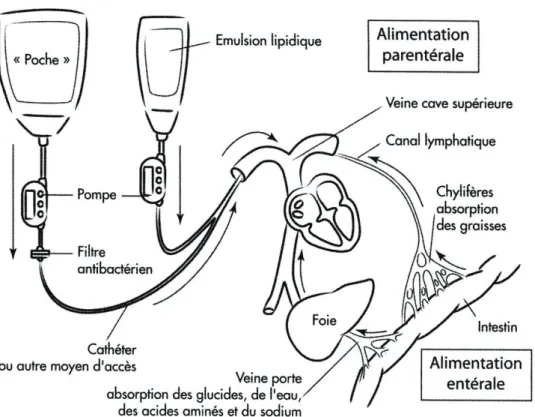 Figure 9 - Nutrition artificielle (Dessins extraits de la bande-dessinée Narcisse : de l’hôpital à la  maison sous nutrition parentérale, réalisée par l’association « La vie par un fil »
