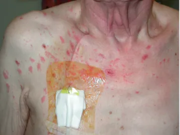 Fig.  1.  Chronic  herpes  zoster  duplex  bilateralis  of  the  right  C4,  T2  dermatomes.