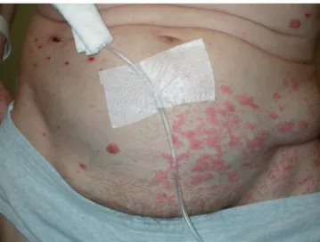 Fig. 2. Chronic herpes zoster duplex bilateralis of the left L 1, 2 dermatomes  in the same patient.