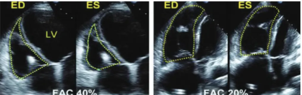 Figure 1A – Mesure de la fraction de raccourcissement de surface du ventricule droit 