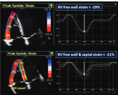 Figure 3 - Mesure du strain ventriculaire droit par 2D speckle tracking 