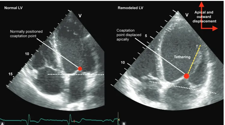 Figure 1A and B: Systolic apical displacement of mitral leaflets and coaptation point relative to the annular plane (white dashed line) in a  patient with ischemic dilated cardiomyopathy and ischemic MR; (B) as compared to a patient with normal LV geometry