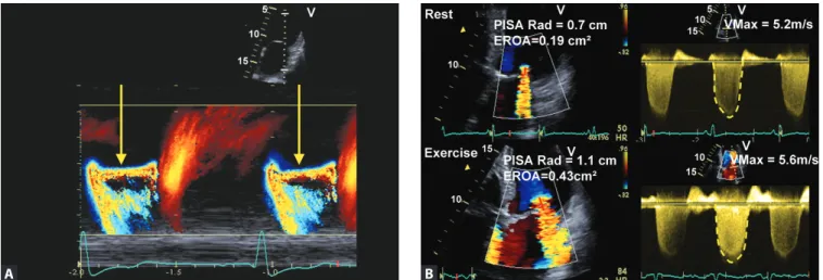 Figure 5A and B: Dynamic trait of ischemic MR with decrease in MR severity in mid-systole as compared to early and late systole [the  arrow indicated that in mid-systole the PISA radius is decreasing as compared to early and late systole (A)] and increase 