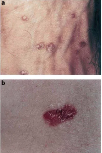 Figure 1 (a) Multiple verrucous VZV lesions on the dorsum of the hand. (b) Single verrucous VZV  lesion on the abdomen
