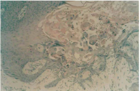 Figure 2 Histological appearance of a verrucous VZV lesion (x 200). 
