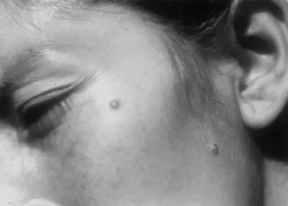 Figure 3 Verruga peruana. Two small papules on the face