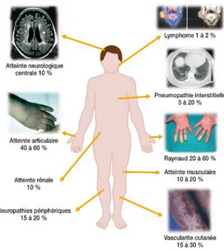 Figure 6 : Schéma des manifestations extra-glandulaires du syndrome de Gougerot-Sjögren 