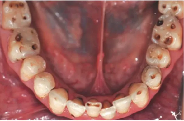 Figure 13 : Érosion dentaire généralisée chez une patiente atteinte du SGS 