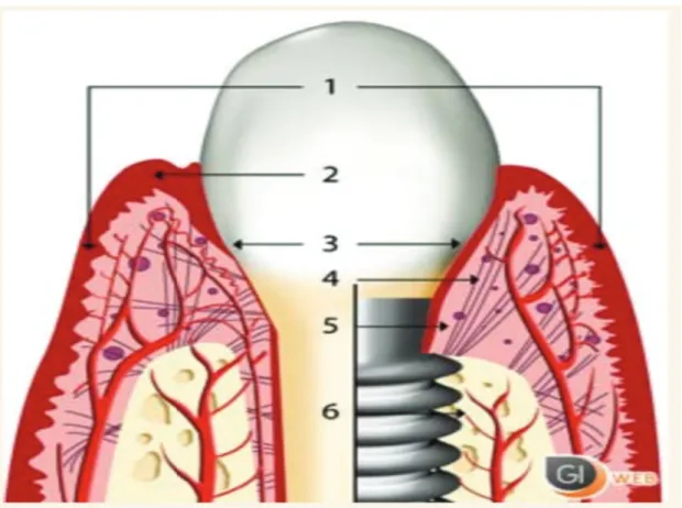 Figure 4 : Similitudes et différences entre tissus mous péri-implantaires et tissus mous  parodontaux (d’après SCLAR) 