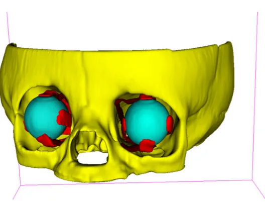 Figure 1: Tridimensional modeling with 3D-Slicer ™ software version 4.10.2, the orbital bones,  oculomotor  rectus  muscles,  superior  and  inferior  oblique  muscles,  and  the  eyeballs  are  represented