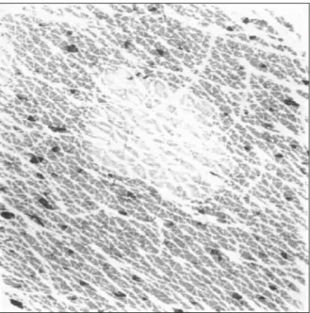 Figure 9 . Psoriatic lesion combining white hyperkeratotic areas and darker inflammatory sites.