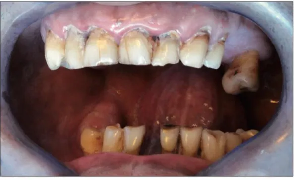 Figure 7 :  Mauvais état dentaire chez un alcoolique