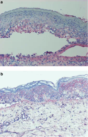 Figure 1. IgG pemphigus-like epidermal deposits before (a) and after (b) a 3-day intravenous immunoglobulin (IVIg) treatment in a toxic epidermal necrolysis (TEN) patient