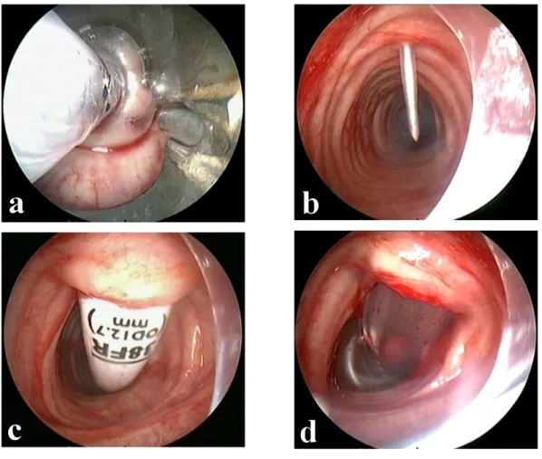 Figure   1:  Vue   endoscopique   lors   de   la   réalisation   d'une   trachéotomie   percutanée   en laryngosuspension