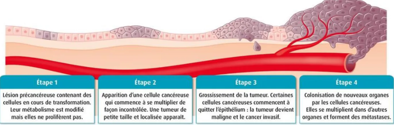 Figure 6 : Les étapes de formation d' un cancer  (40)  