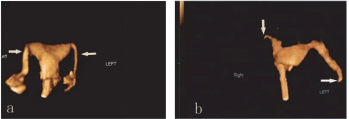 Figure 18 : Acquisition 4D-HyCoSy  a. perméabilité tubaire bilatérale 