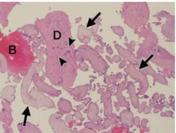 Figure 12. Microscopie optique x4. Pièce d’aspiration curetage 1mois après FCS à 8 SA montrant les  villosités choriales perfusées par le sang maternel (B) et des fragments de cellules déciduales utérines (D)  (21) 
