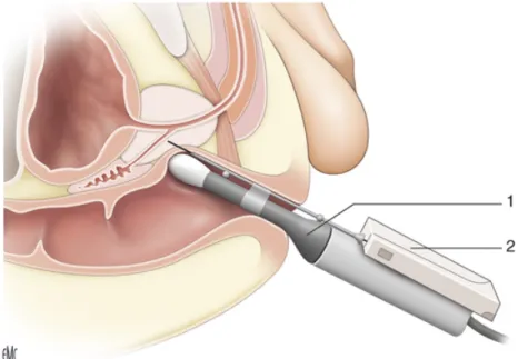 Figure 8 : Biopsies de prostate transrectales sous contrôle échographique. 1. Sonde  échographique endorectale ; 2