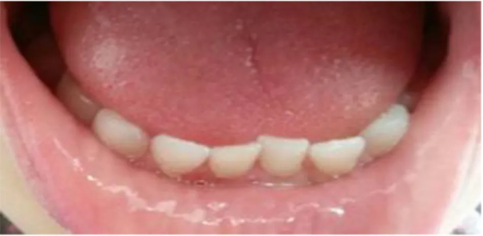 Figure 5 : Cas clinique présentant l’absence de diastème de Bogue accompagné d’un  encombrement des incisives mandibulaires en denture temporaire