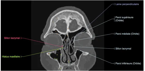 Figure  11 :  Coupe  frontale  de  scanner  de  la  tête  en  fenêtre  osseuse  passant  par  les  orbites et le canal lacrymonasal