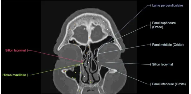 Figure  11 :  Coupe  frontale  de  scanner  de  la  tête  en  fenêtre  osseuse  passant  par  les  orbites et le canal lacrymonasal