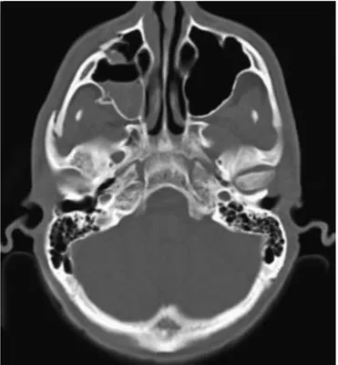 Figure  18 :  Tomodensitométrie.  Fracture  orbitozygomatique  droite  avec  hémosinus  maxillaire droit associé en coupe axiale