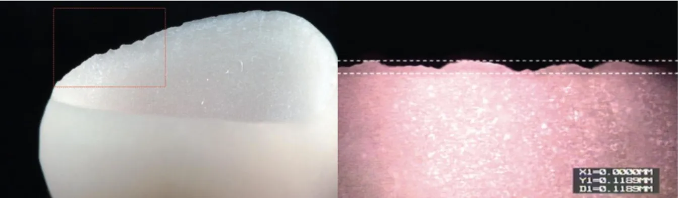 Figure 5 : Macro-photographie (à gauche) et micro-photographie (à droite) de la limite marginale  d’une restauration réalisée  en VitaMarkII (céramique feldspathique) par CFAO 