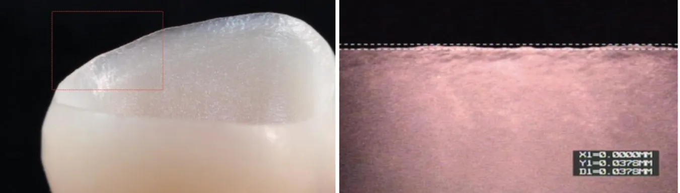 Figure 12 : Macro-photographie (à gauche) et micro-photographie (à droite) de la limite marginale  d’une restauration réalisée  en Cerasmart (composite nanochargée) par CFAO 