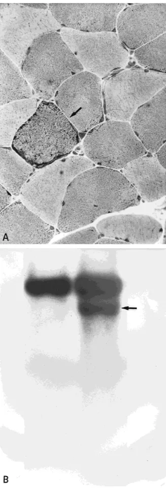 FIGURE 1. (A) Cryostat section stained with hematoxylin and eosin showing a characteristic ‘‘ragged red fiber.’’ (B) Southern blot hybridization analysis of DNA from a healthy control (left) and our patient (right)