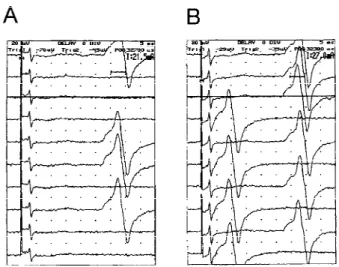 FIGURE 1. Surface-recorded single thenar motor unit H reflex (MUP H ) in a amyotrophic lateral sclerosis patient