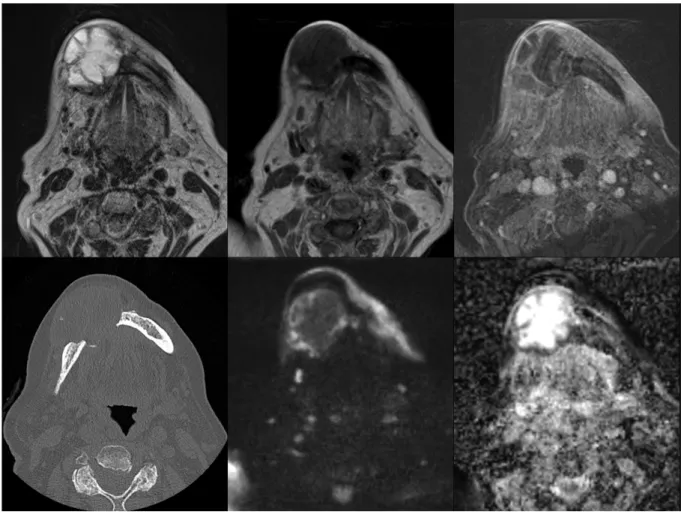 Figure  4.  Exemple  d’un  Améloblastome :  patiente  de  88  ans,  tuméfaction  mandibulaire  d’évolution progressive, en TDM : lésion soufflant les corticales avec envahissement des parties  molles, d’aspect multi-cloisonné en IRM (de gauche à droite): h